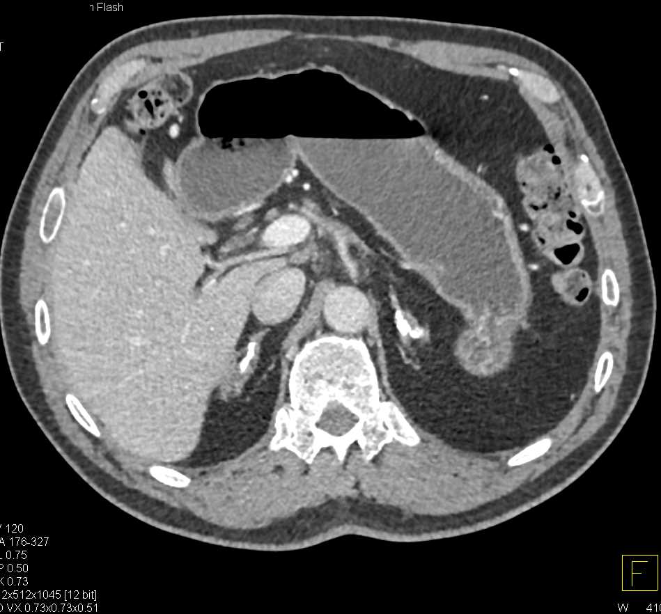 Calcified Adrenal Glands due to Prior Tuberculosis (TB) - CTisus CT Scan
