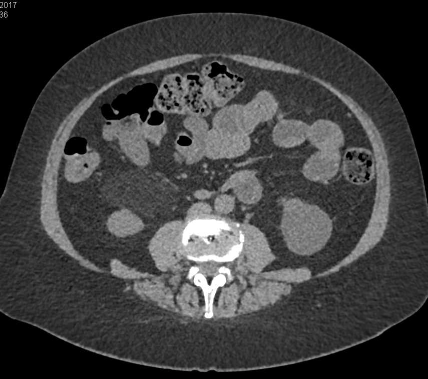 Myelolipoma Right Adrenal Gland - CTisus CT Scan