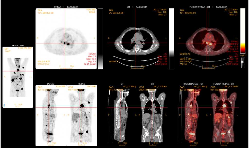 Esophageal Cancer with Widespread Metastases - CTisus CT Scan