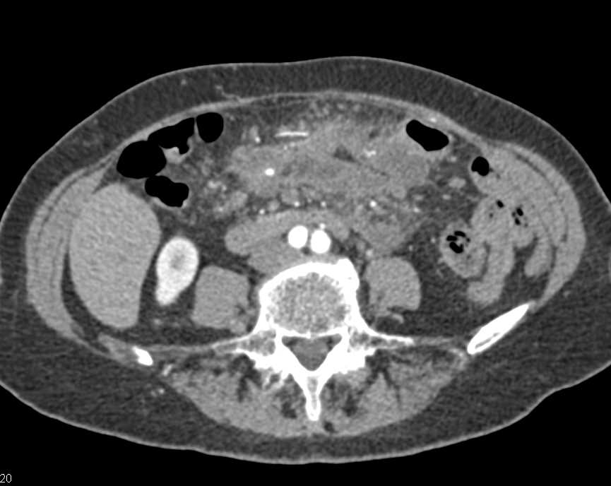 Abscess in the Root of the Mesentery - CTisus CT Scan