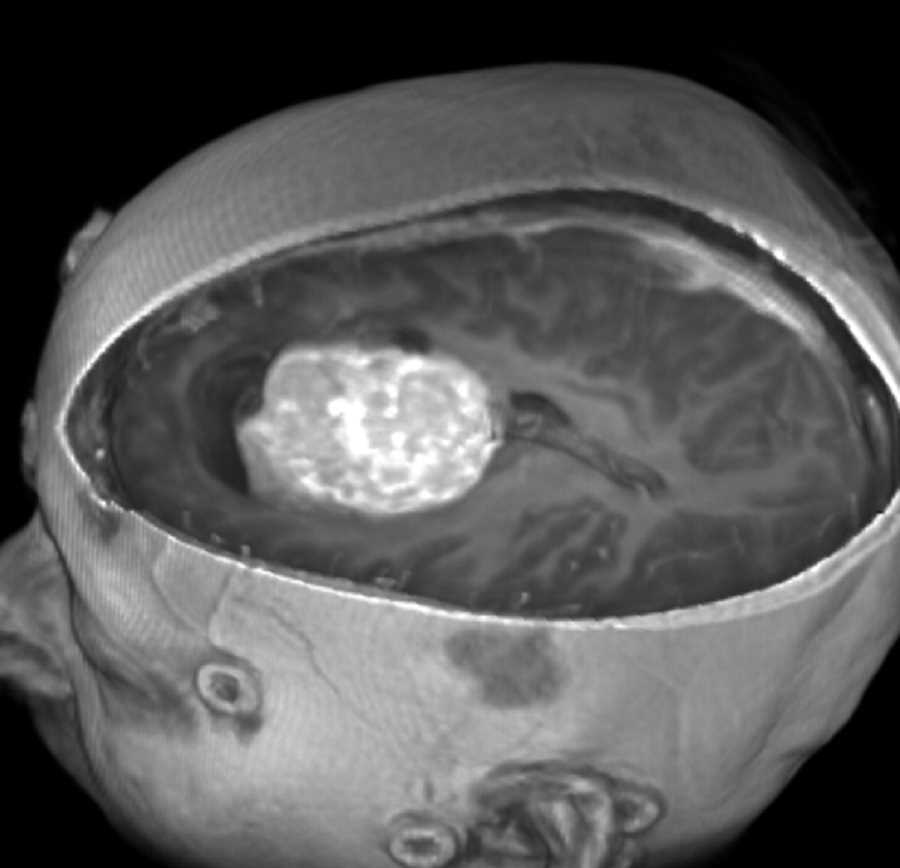 Anaplastic Intraventricular Ependymoma - CTisus CT Scan