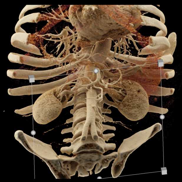 Small Bowel Obstruction (SBO) with Midgut Volvulus with Cinematic Rendering - CTisus CT Scan