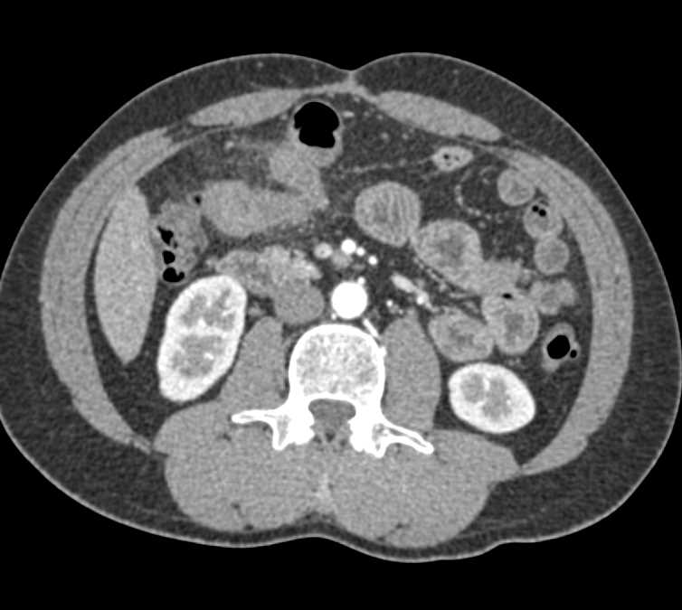 SBO with Thickened Small Bowel Folds - CTisus CT Scan